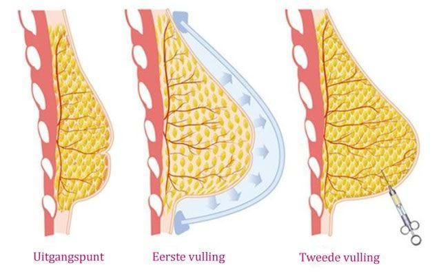 borstvergroting met eigen vet lipofilling