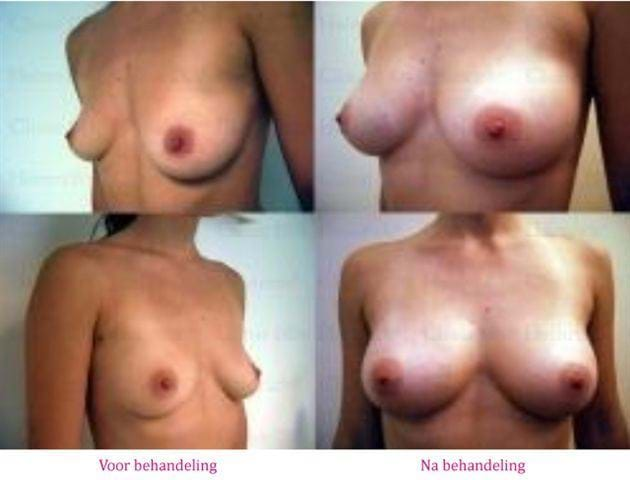 borstvergroting met lipofilling voor na 2