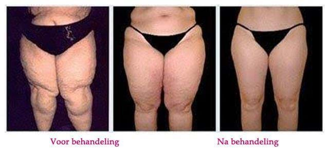 WAL water liposuctie behandeling