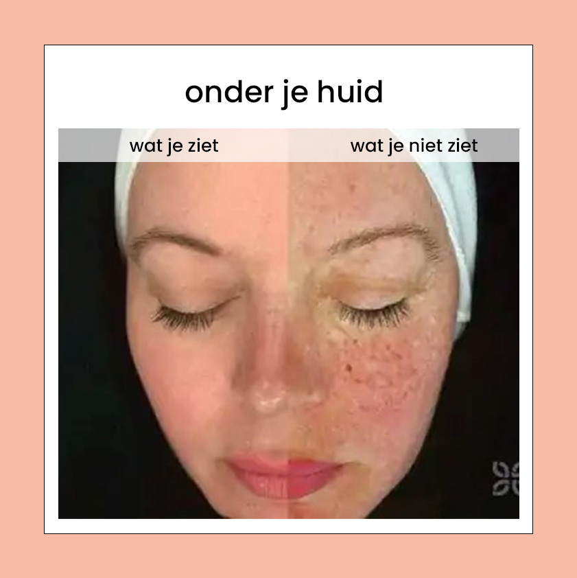 Onder je huid