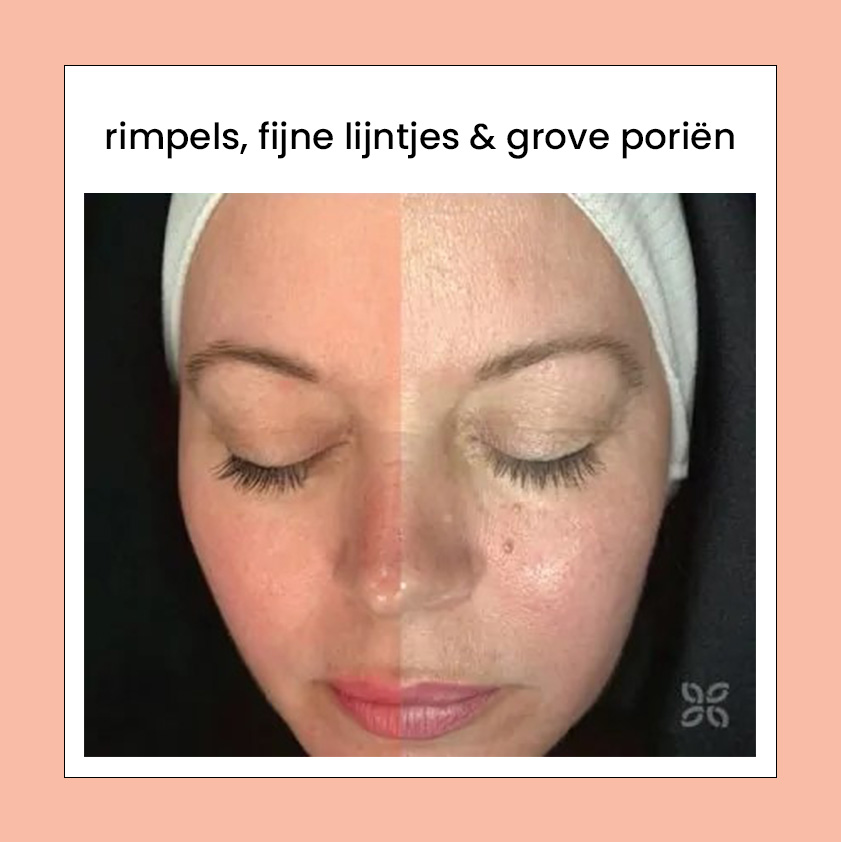 Rimpels, fijne lijntjes en grove poriën
