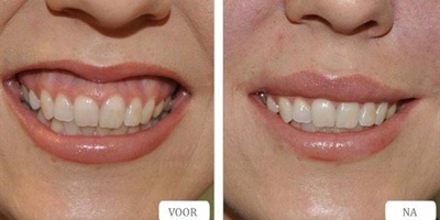 Kan je een Gummy smile behandelen met rimpel injecties?