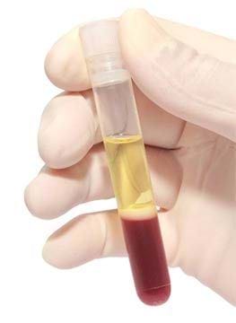 PRP platelet rich plasma
