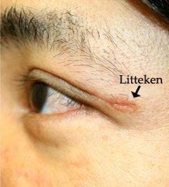bovenoog-lidcorrectie-litteken