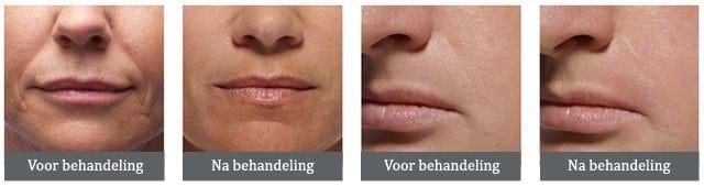 fillers voor na 1