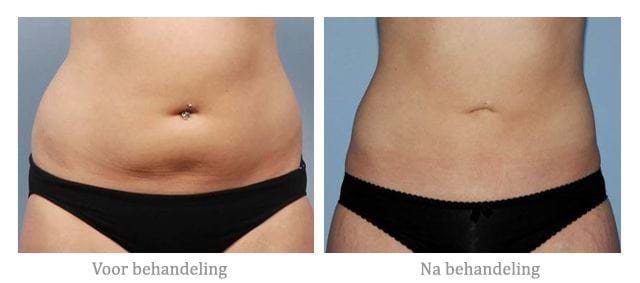 cellulite