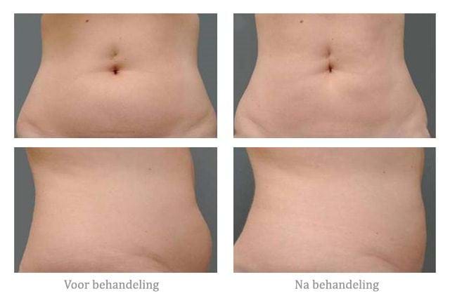 cellulite voor/na