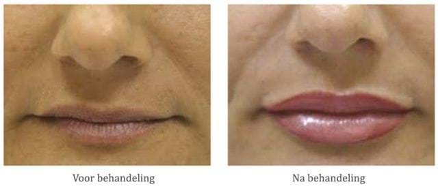 Lippen met fillers behandelen - voor na behandeling