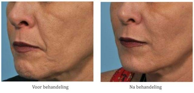 fillers voor neuslippenplooi - voor na behandeling