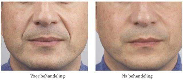 neuslippenplooi fillers - voor na behandeling