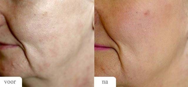 Voor Na MedArt FRx Fractional CO2 Laser
