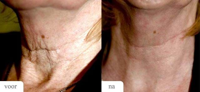 Voor Na MedArt FRx Fractional CO2 Laser