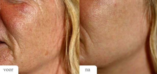 Voor Na MedArt FRx Fractional CO2 Laser