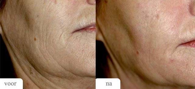 Voor Na MedArt FRx Fractional CO2 Laser