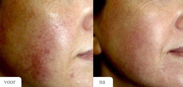 Voor Na MedArt FRx Fractional CO2 Laser