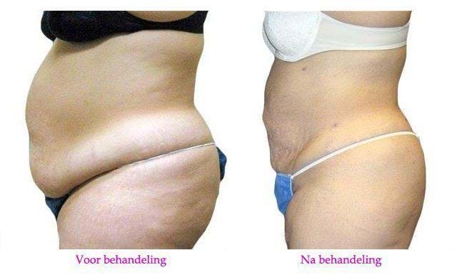 ervaringen liposuctie buik