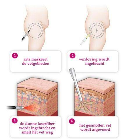 laser liposuctie