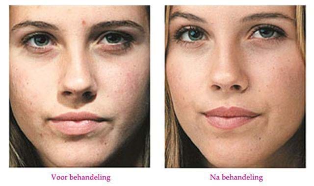 OxyGeneo voor na behandeling