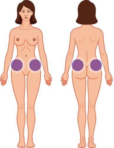 Gebied love handles en heupen