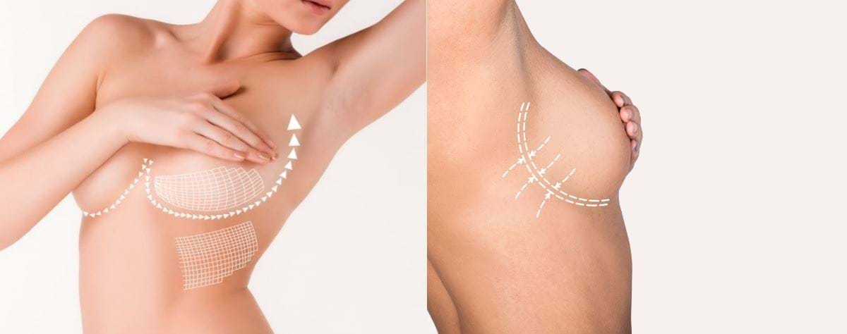 liposuctie borsten