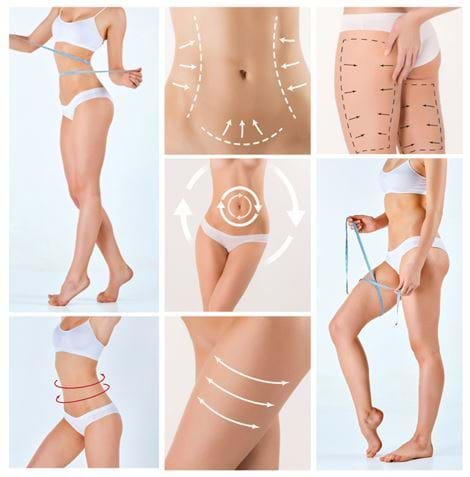 liposuctie gebieden