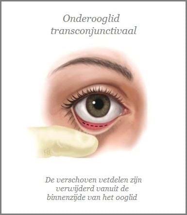 onderooglidcorrectie