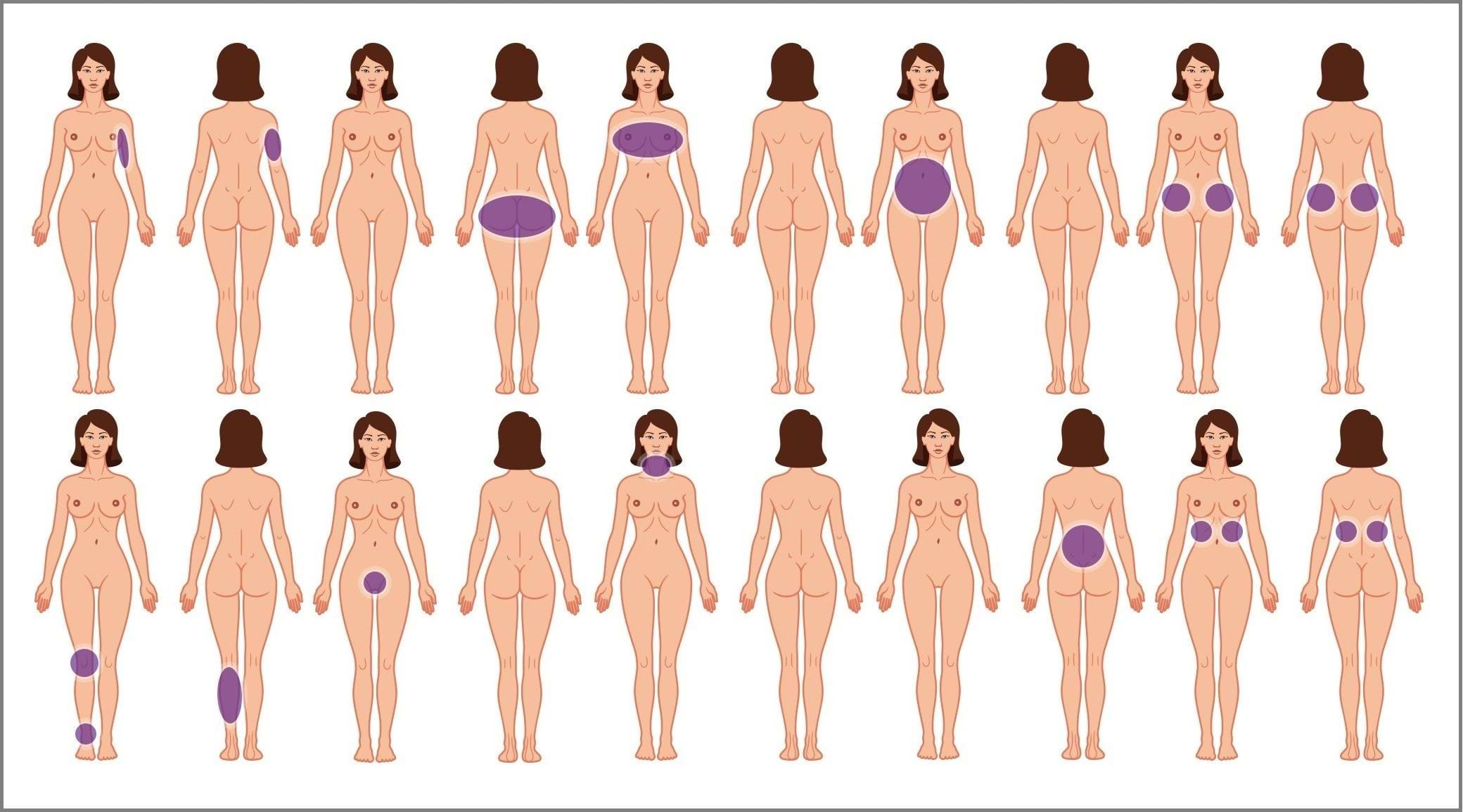 liposuctie zones