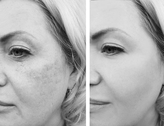 Vitamine A tegen couperose