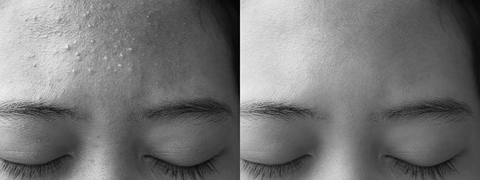 Vitamine A vermindert puistjes en keratosis pilaris
