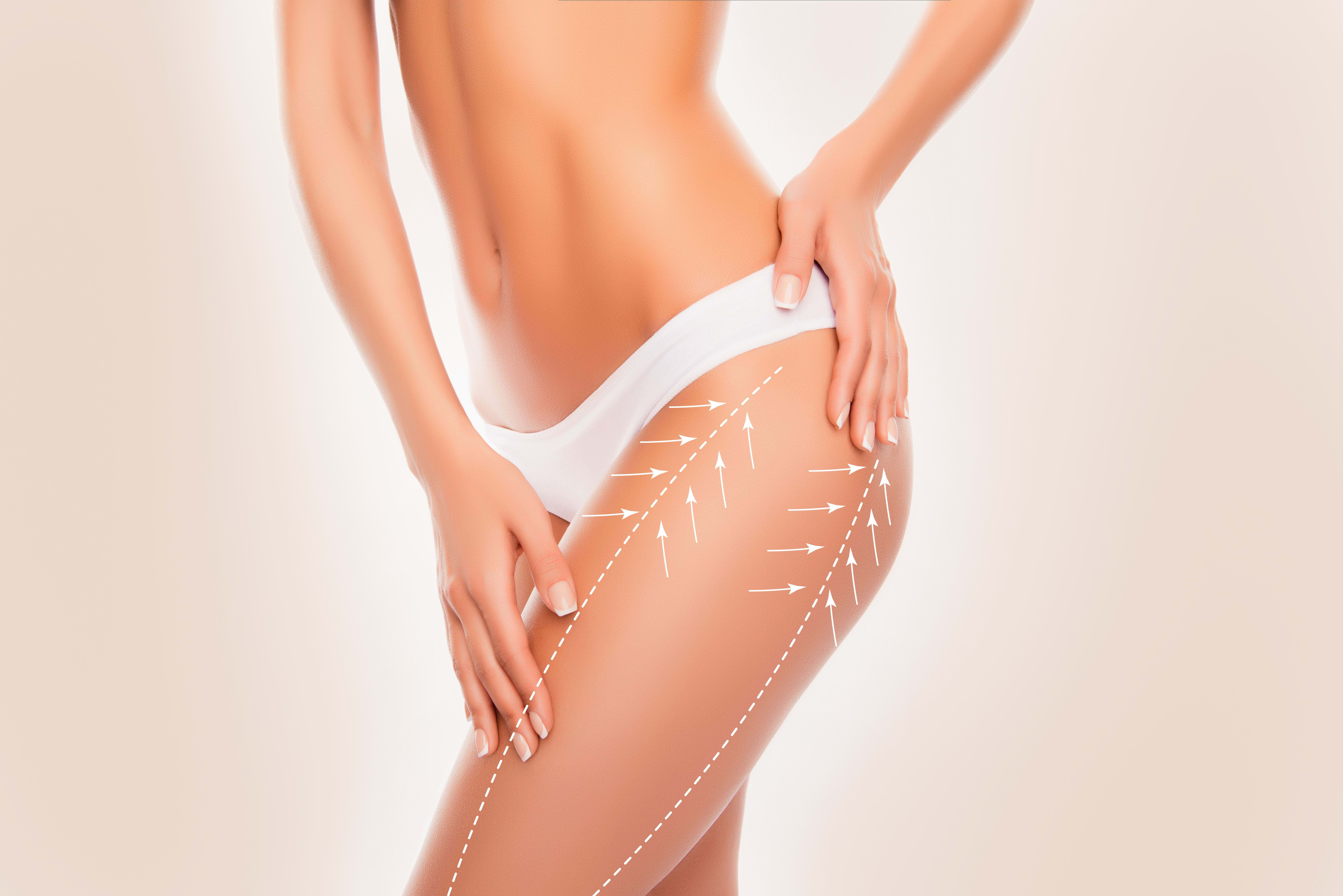 liposuctie benen