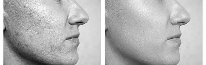 Vitamine A vermindert acné