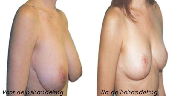 liposuctie borsten voor en na