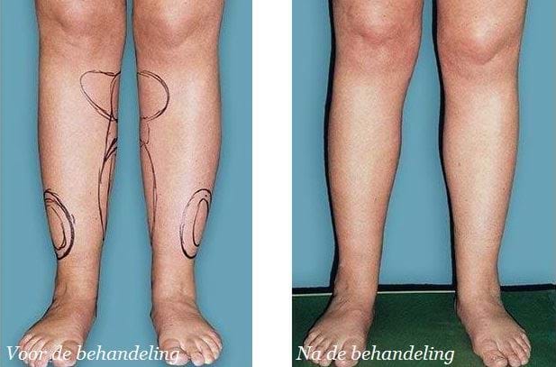 liposuctie bovenbenen voor en na 