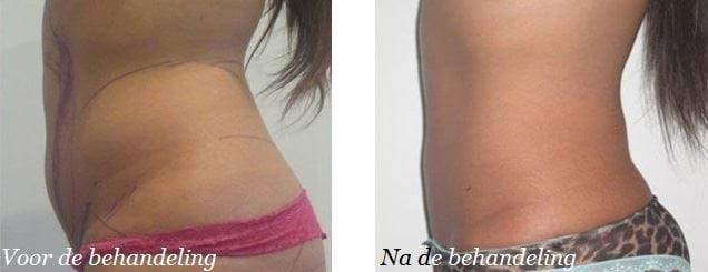 liposuctie buik voor en na