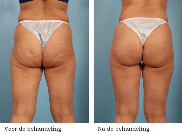 cellulite behandeling voor en na