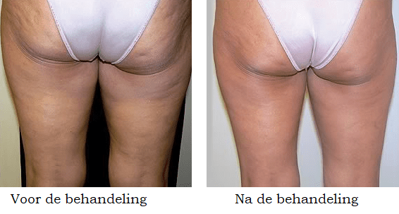 cellulite behandeling voor en na