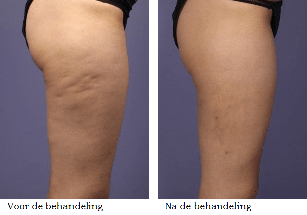 cellulite behandeling voor en na