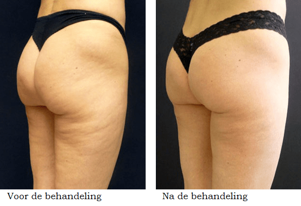 cellulite behandeling voor en na