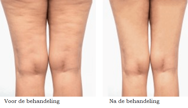 cellulite behandeling voor en na