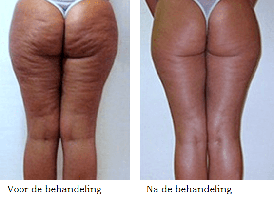 cellulite behandeling voor en na