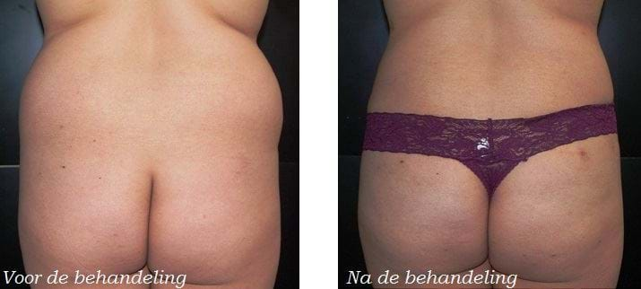 liposuctie love handles voor en na