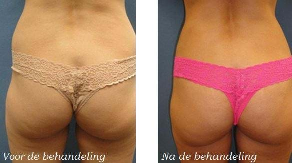 liposuctie love handles voor en na