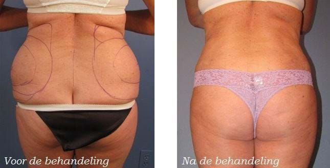 liposuctie love handles voor en na 